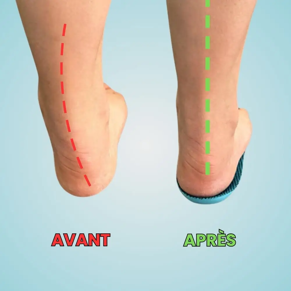 Solévia™ – Semelles Orthopédiques Anti-Douleur