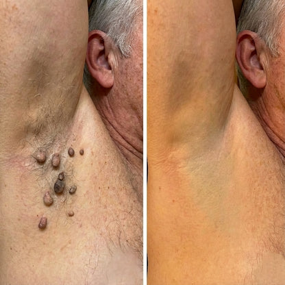 Crème anti-verrues et Acrochordons DermaClear™